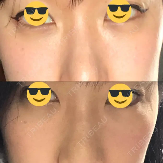 クマ治療 / 下まぶたの脂肪取り 韓国ST美容整形外科 AFTER メイン用