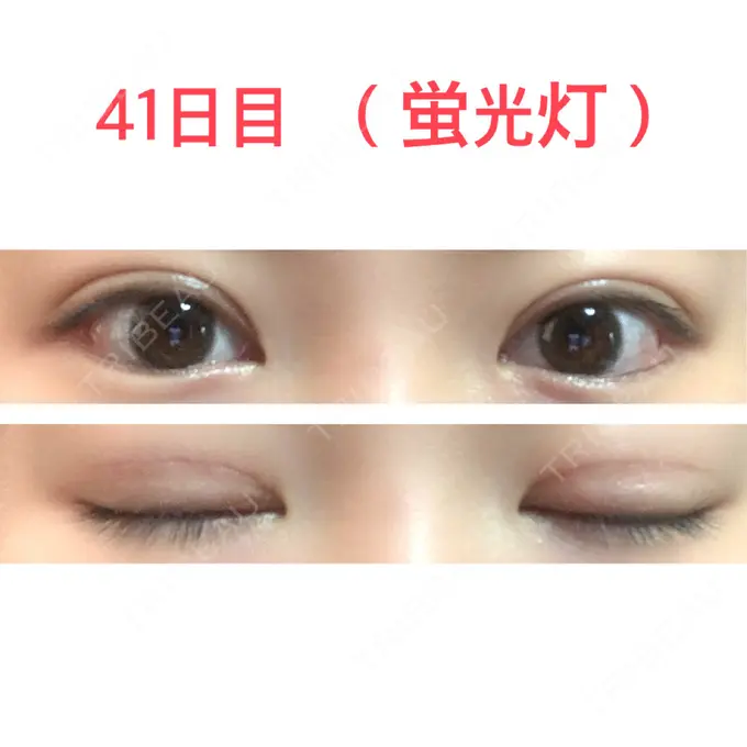 二重切開 水の森美容クリニック 東京新宿院 DAY 41 メイン用