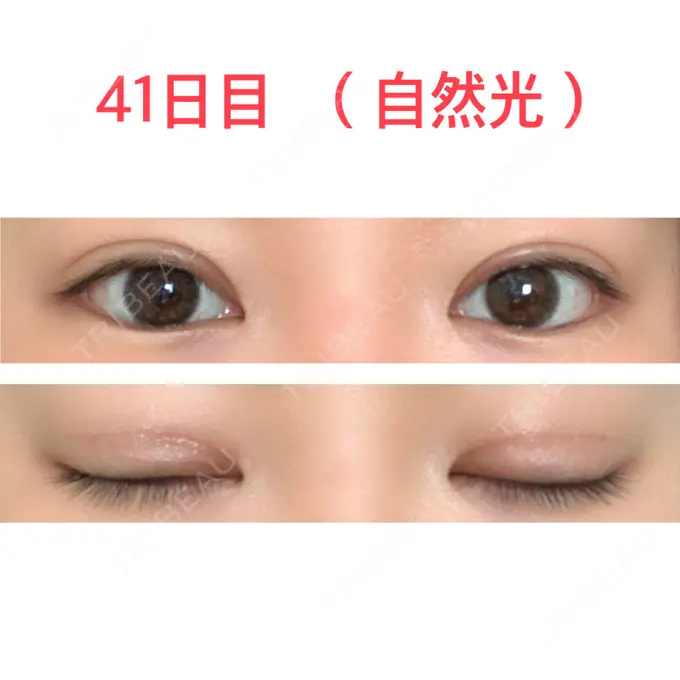 二重切開 水の森美容クリニック 東京新宿院 DAY 41 メイン用