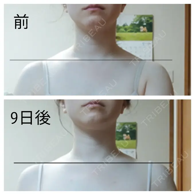 ボトックス（肩） もとび美容外科クリニック 新宿院 DAY 9 メイン用