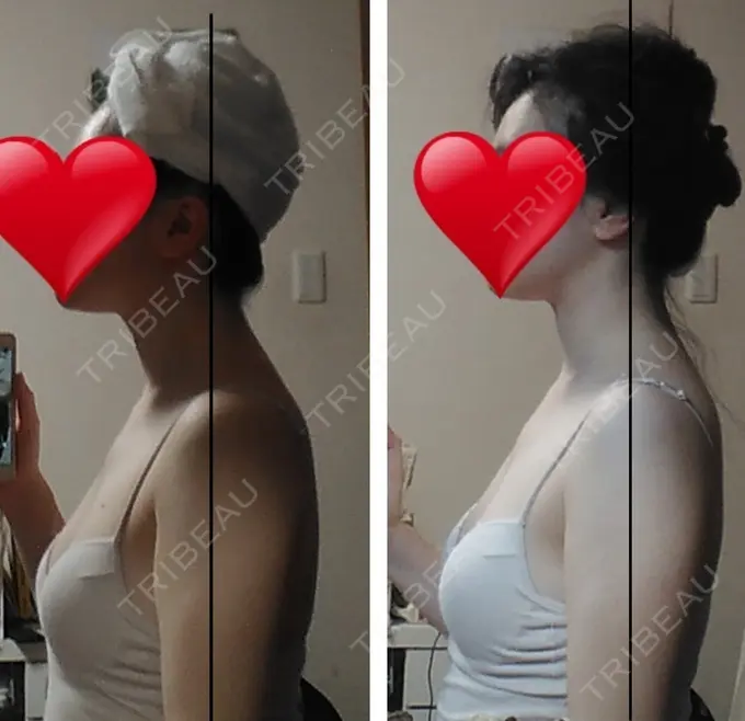 ボトックス（肩） もとび美容外科クリニック 新宿院 DAY 9 メイン用