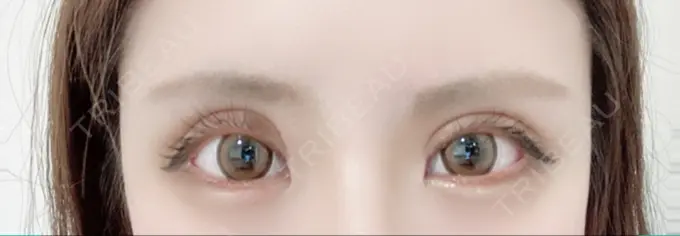 二重切開 / 目元修正 心斎橋コムロ美容外科クリニック DAY 103 メイン用