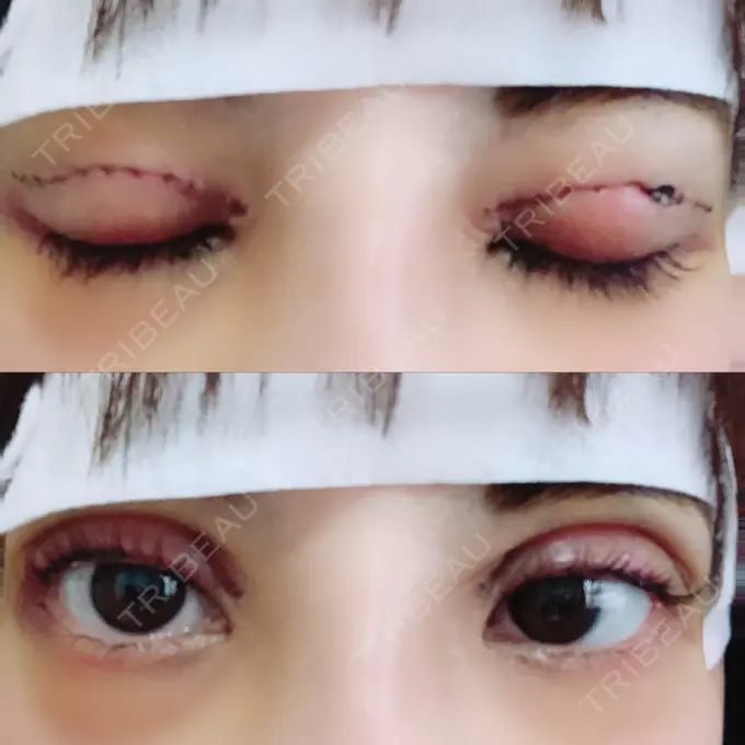 二重切開 / ヒアルロン酸注入（鼻） 品川スキンクリニック沖縄院 DAY 3 メイン用