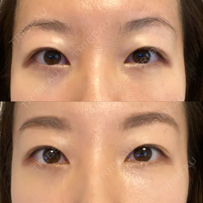 クマ治療 X CLINIC 恵比寿院 DAY 10 メイン用