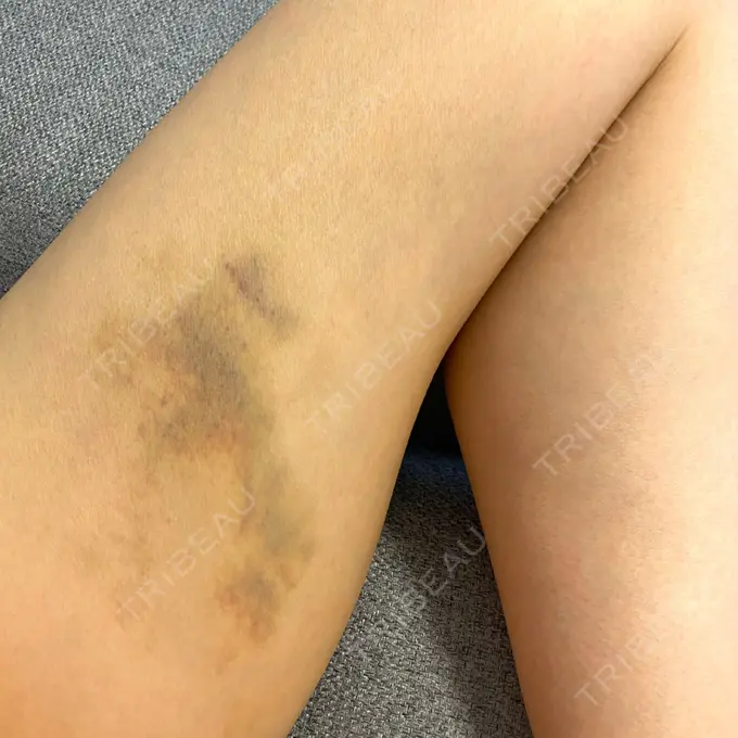 クマ治療 X CLINIC 恵比寿院 DAY 10 メイン用