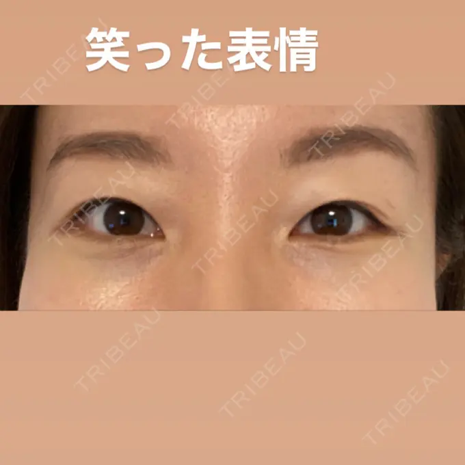 クマ治療 X CLINIC 恵比寿院 DAY 10 メイン用