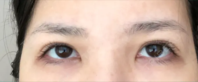眼瞼下垂（切開） あきこクリニック AFTER メイン用