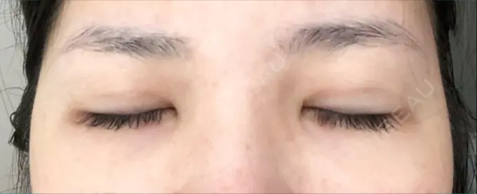 眼瞼下垂（切開） あきこクリニック DAY 116 メイン用