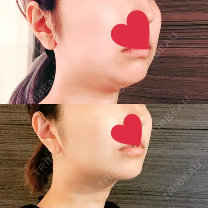 糸リフト / バッカルファット除去 / 脂肪吸引（顔） / メーラーファット除去 / ボトックス（あご） WOM CLINIC GINZA （ワム クリニック ギンザ） DAY 98 メイン用