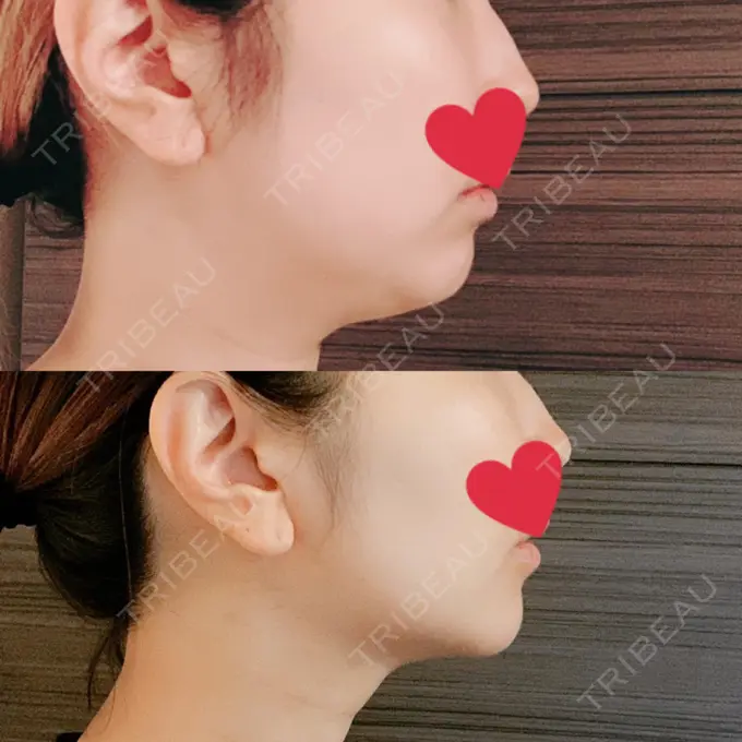 糸リフト / バッカルファット除去 / 脂肪吸引（顔） / メーラーファット除去 / ボトックス（あご） WOM CLINIC GINZA （ワム クリニック ギンザ） DAY 98 メイン用