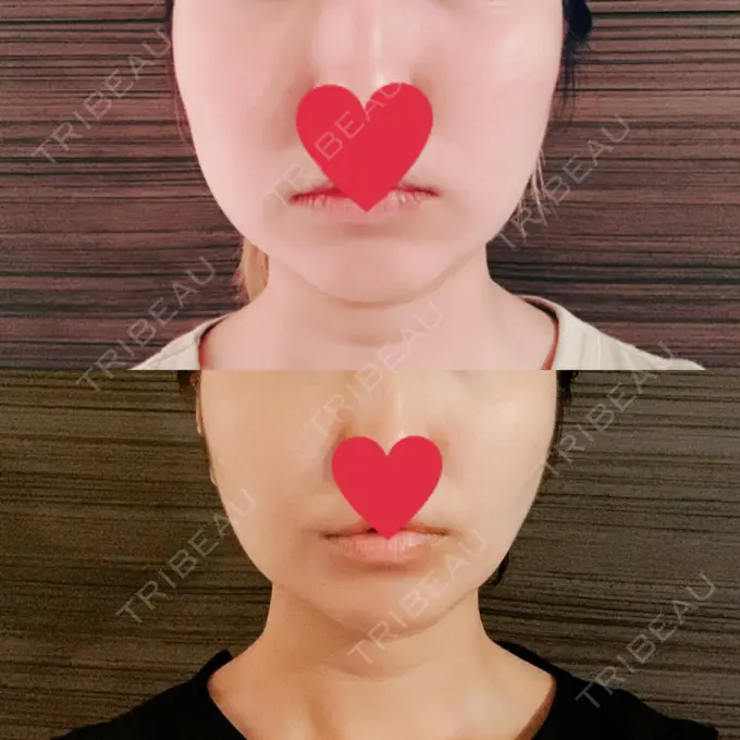 糸リフト / バッカルファット除去 / 脂肪吸引（顔） / メーラーファット除去 / ボトックス（あご） WOM CLINIC GINZA （ワム クリニック ギンザ） DAY 98 メイン用