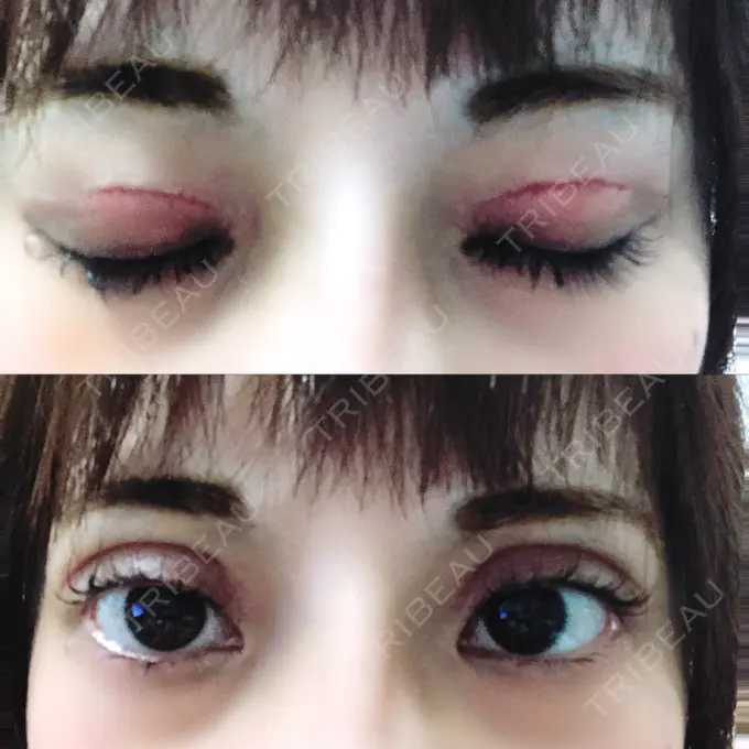 二重切開 / ヒアルロン酸注入（鼻） 品川スキンクリニック沖縄院 DAY 7 メイン用