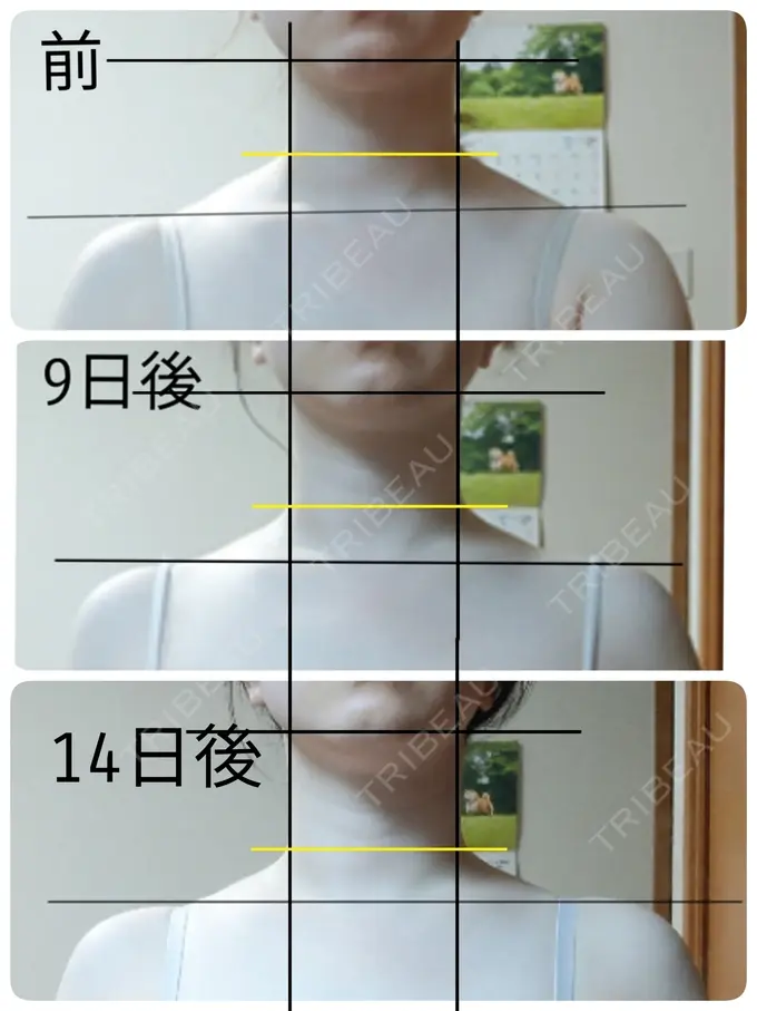 ボトックス（肩） もとび美容外科クリニック 新宿院 DAY 14 メイン用