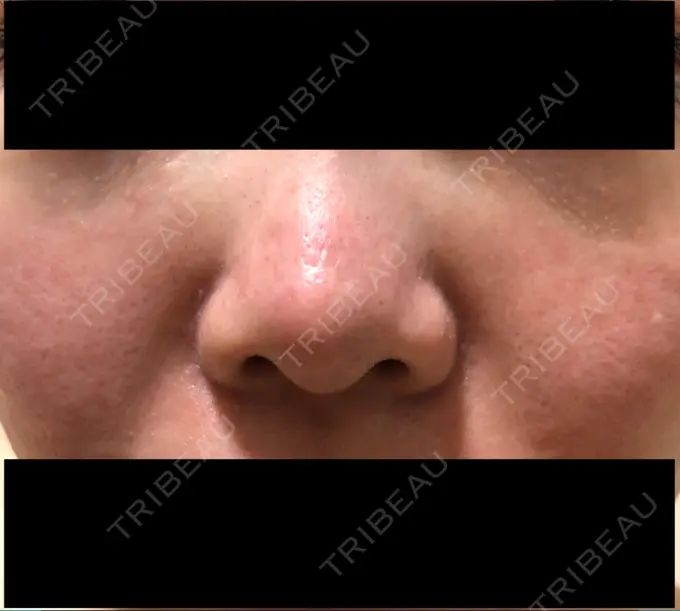 ピーリング（ニキビ・毛穴） / 美肌レーザー みやた形成外科・皮ふクリニック DAY 2 メイン用