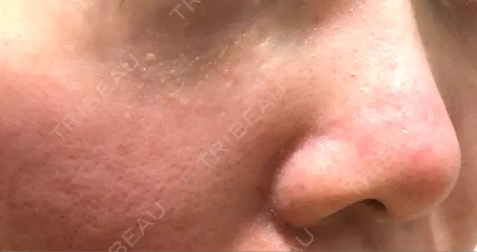 ピーリング（ニキビ・毛穴） / 美肌レーザー みやた形成外科・皮ふクリニック DAY 2 メイン用