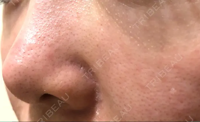 ピーリング（ニキビ・毛穴） / 美肌レーザー みやた形成外科・皮ふクリニック DAY 3 メイン用