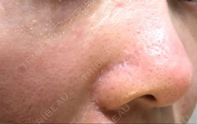 ピーリング（ニキビ・毛穴） / 美肌レーザー みやた形成外科・皮ふクリニック DAY 3 メイン用