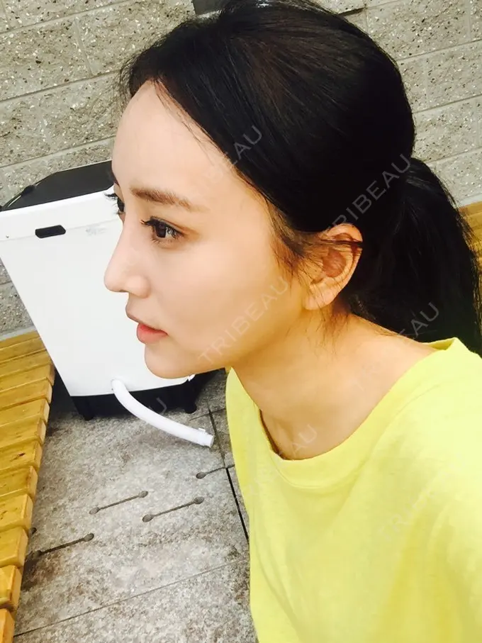 二重埋没 / 隆鼻術 / 鼻尖形成（切開） / 鼻中隔延長（切開） / 骨切り（あご） / 骨削り（エラ） / 骨削り（頬） / 軟骨移植 / ワシ鼻修正・ハンプ切除 DA美容外科 DAY 121 メイン用