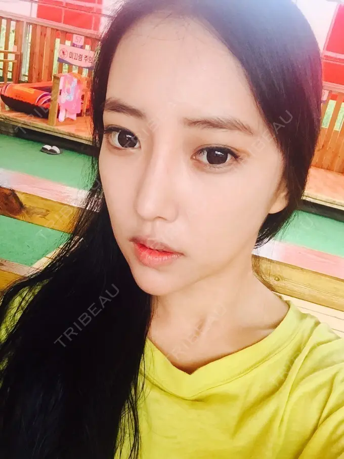 二重埋没 / 隆鼻術 / 鼻尖形成（切開） / 鼻中隔延長（切開） / 骨切り（あご） / 骨削り（エラ） / 骨削り（頬） / 軟骨移植 / ワシ鼻修正・ハンプ切除 DA美容外科 DAY 121 メイン用