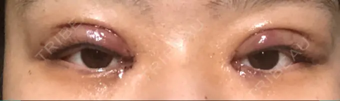 二重切開 / 目頭切開 Wクリニック 心斎橋院 DAY 1 メイン用