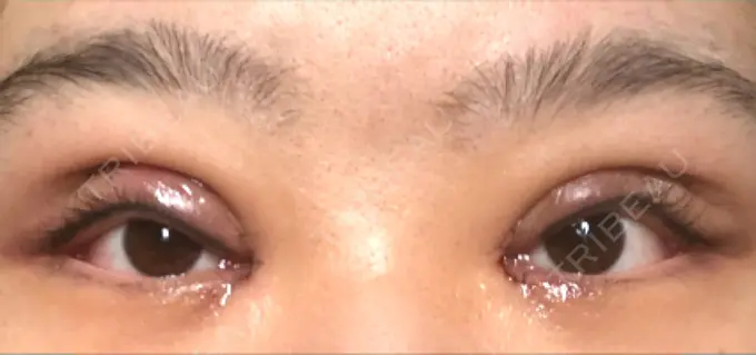 二重切開 / 目頭切開 Wクリニック 心斎橋院 DAY 2 メイン用