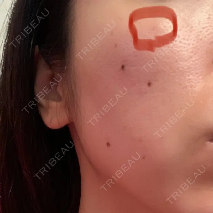 シミ取りレーザー Dual Clinic KOBE DAY 6 メイン用