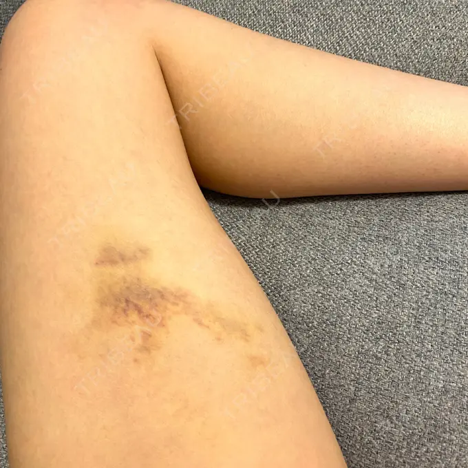 クマ治療 X CLINIC 恵比寿院 DAY 14 メイン用