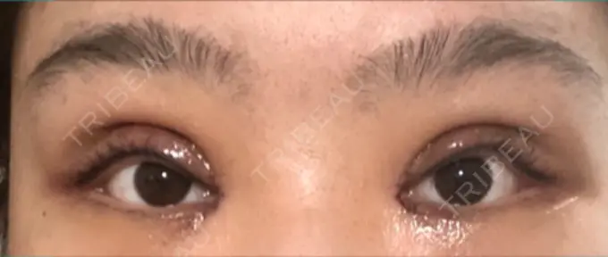 二重切開 / 目頭切開 Wクリニック 心斎橋院 DAY 2 メイン用