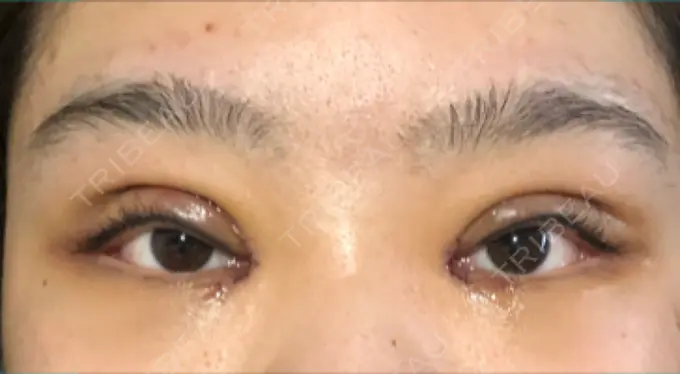 二重切開 / 目頭切開 Wクリニック 心斎橋院 AFTER メイン用