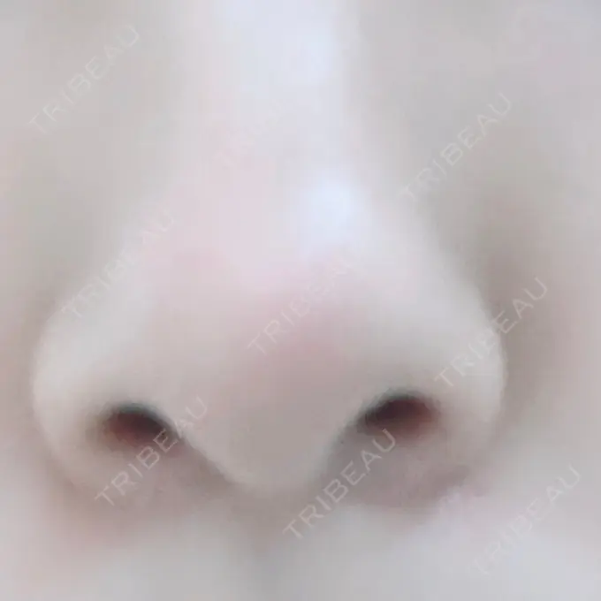 小鼻縮小（切開） TCB東京中央美容外科 渋谷西口院 DAY 0 メイン用