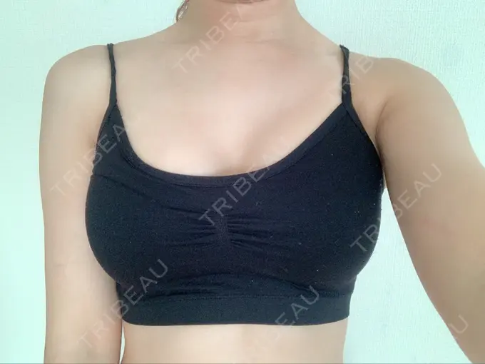 豊胸（シリコンバッグ） ウォンジン（Wonjin）整形外科 AFTER メイン用