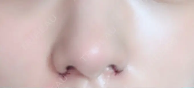 小鼻縮小（切開） TCB東京中央美容外科 渋谷西口院 DAY 0 メイン用