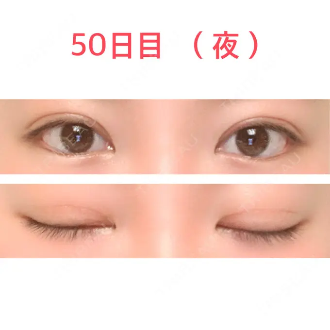 二重切開 水の森美容クリニック 東京新宿院 DAY 50 メイン用