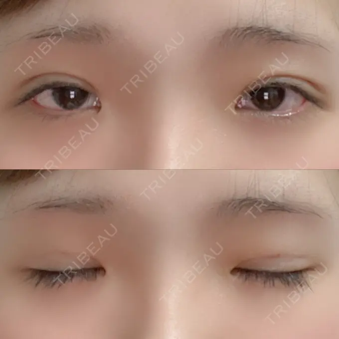 二重埋没 湘南美容クリニック 赤坂見附院 DAY 9 メイン用