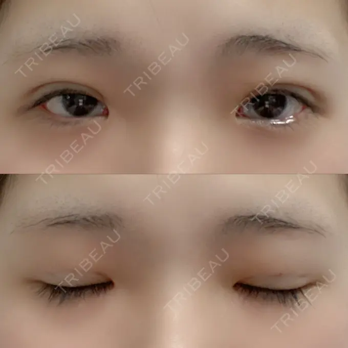 二重埋没 湘南美容クリニック 赤坂見附院 DAY 9 メイン用