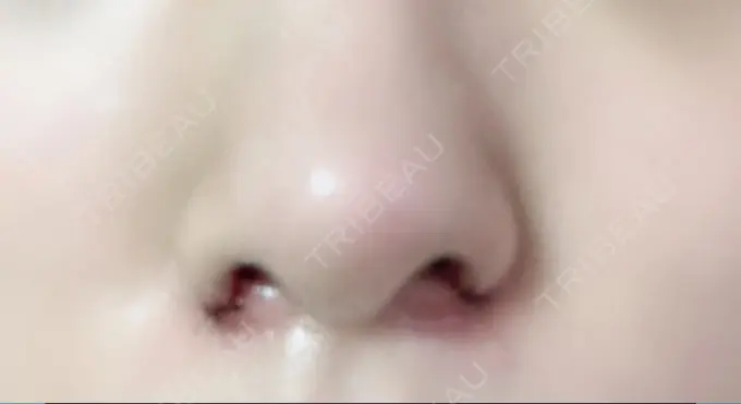 小鼻縮小（切開） TCB東京中央美容外科 渋谷西口院 DAY 1 メイン用