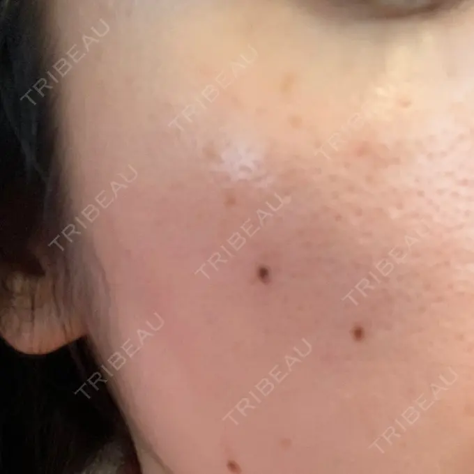 シミ取りレーザー Dual Clinic KOBE DAY 8 メイン用