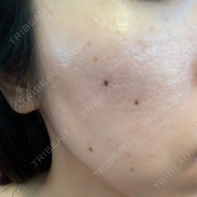 シミ取りレーザー Dual Clinic KOBE DAY 8 メイン用