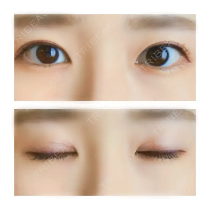 二重切開 有楽町高野美容クリニック AFTER メイン用