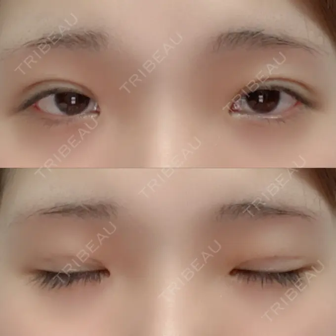 二重埋没 湘南美容クリニック 赤坂見附院 DAY 10 メイン用