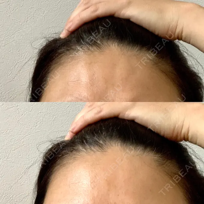 額を丸く / シワ取りボトックス 銀座3丁目・BANNAI美容クリニック DAY 9 メイン用