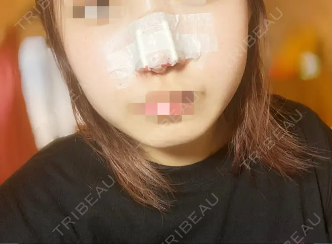 脂肪溶解注射（顔） TCB東京中央美容外科 心斎橋筋院 DAY 0 メイン用