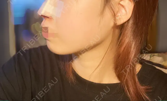 脂肪溶解注射（顔） TCB東京中央美容外科 心斎橋筋院 DAY 0 メイン用