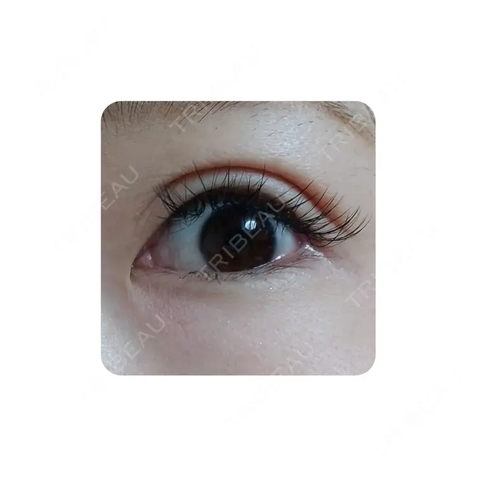 二重切開 カリスクリニック AFTER メイン用