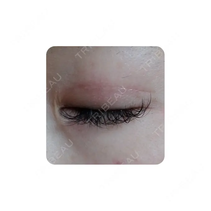 二重切開 カリスクリニック DAY 45 メイン用