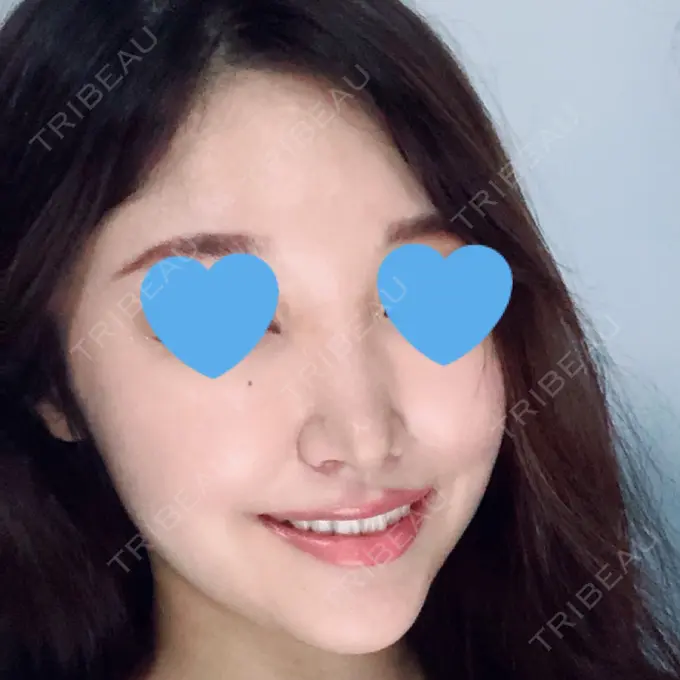 鼻尖形成（切開） / 小鼻縮小（切開） みずほクリニック DAY 9 メイン用