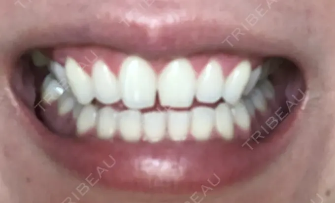 その他（審美歯科/矯正歯科） 南青山矯正歯科 AFTER メイン用