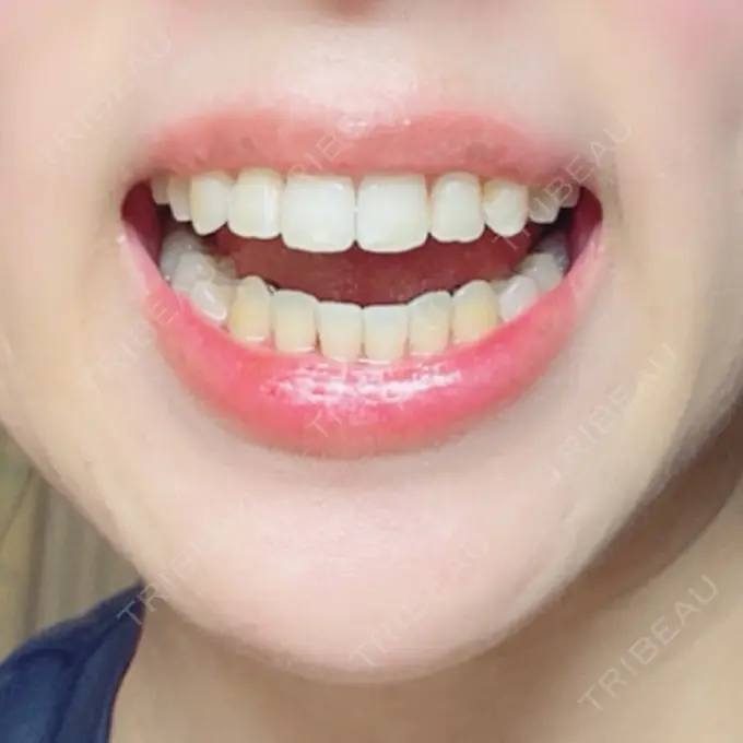 矯正（ワイヤー） アトラスタワー歯科 DAY 196 メイン用