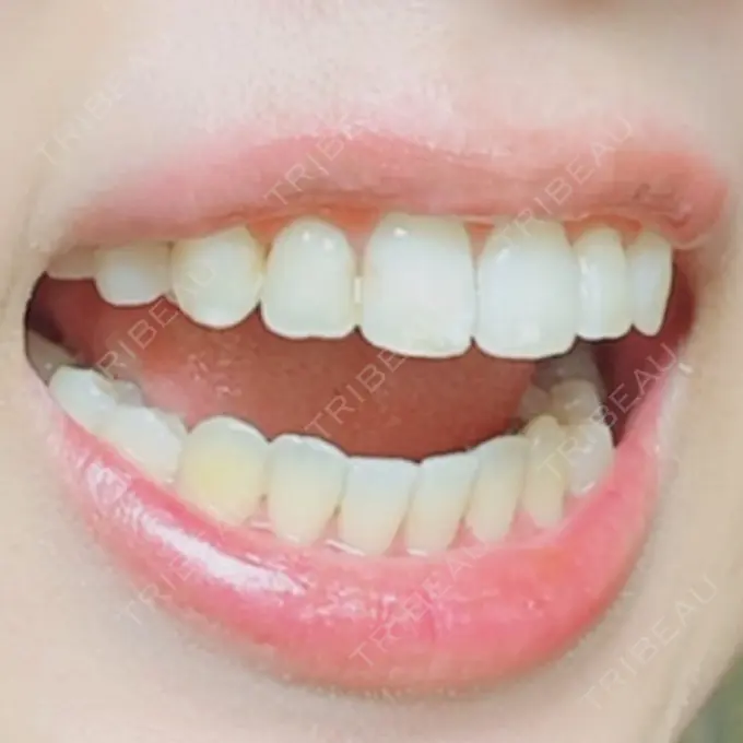 矯正（ワイヤー） アトラスタワー歯科 DAY 196 メイン用