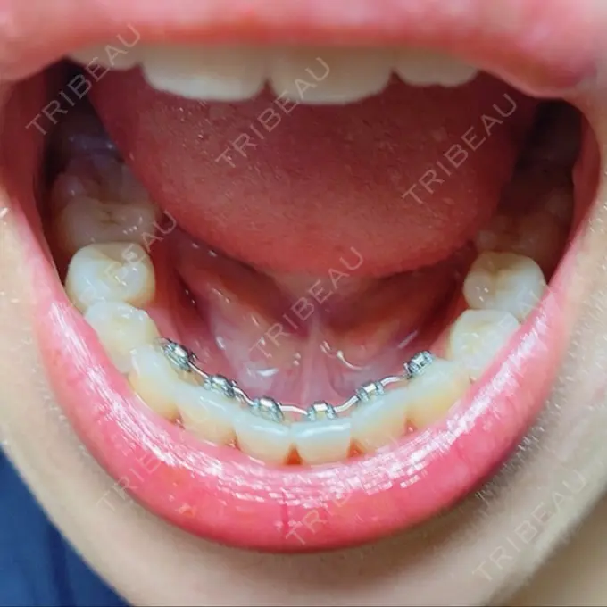 矯正（ワイヤー） アトラスタワー歯科 DAY 196 メイン用